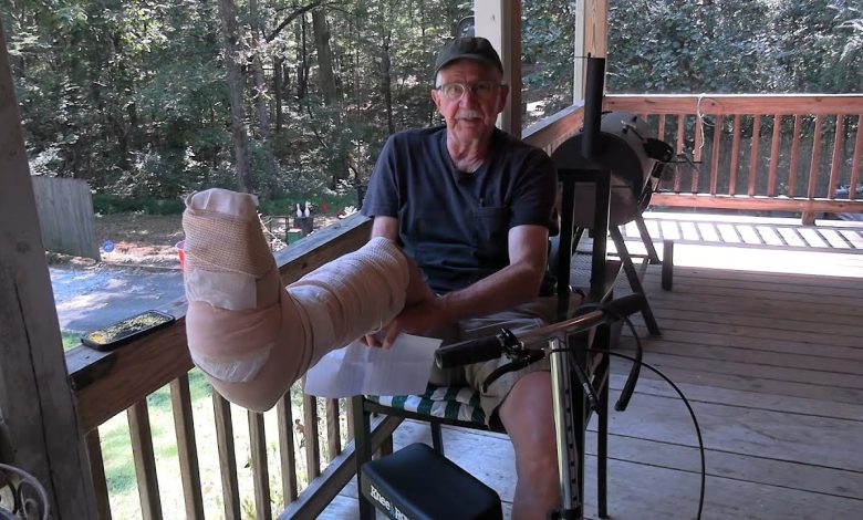 I Broke my Leg!