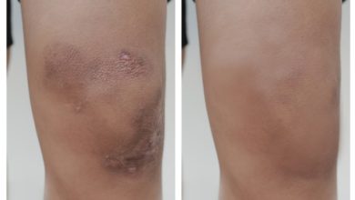 Old Style Bone And Bruise Care – From Arnica To Comfrey Poultices – Survivopedia Old Style Bone And Bruise Care – From Arnica To Comfrey Poultices – Survivopedia