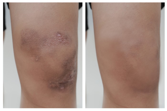 Old Style Bone And Bruise Care – From Arnica To Comfrey Poultices – Survivopedia Old Style Bone And Bruise Care – From Arnica To Comfrey Poultices – Survivopedia